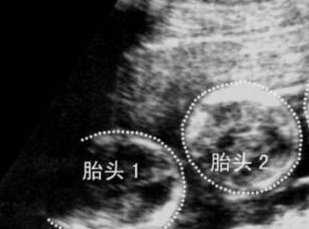 做了结扎手术可以在哈密市试管医院做试管婴儿吗？费用是多少